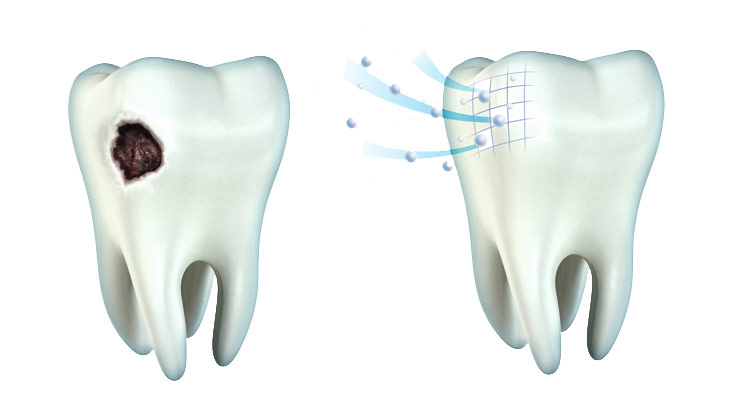 How to Strengthen Tooth Enamel with the Process of Remineralization